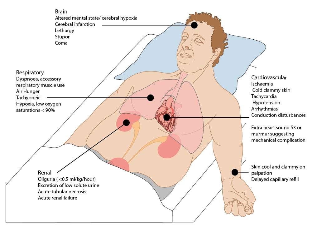 Cardiogenic shock - human body diagram.