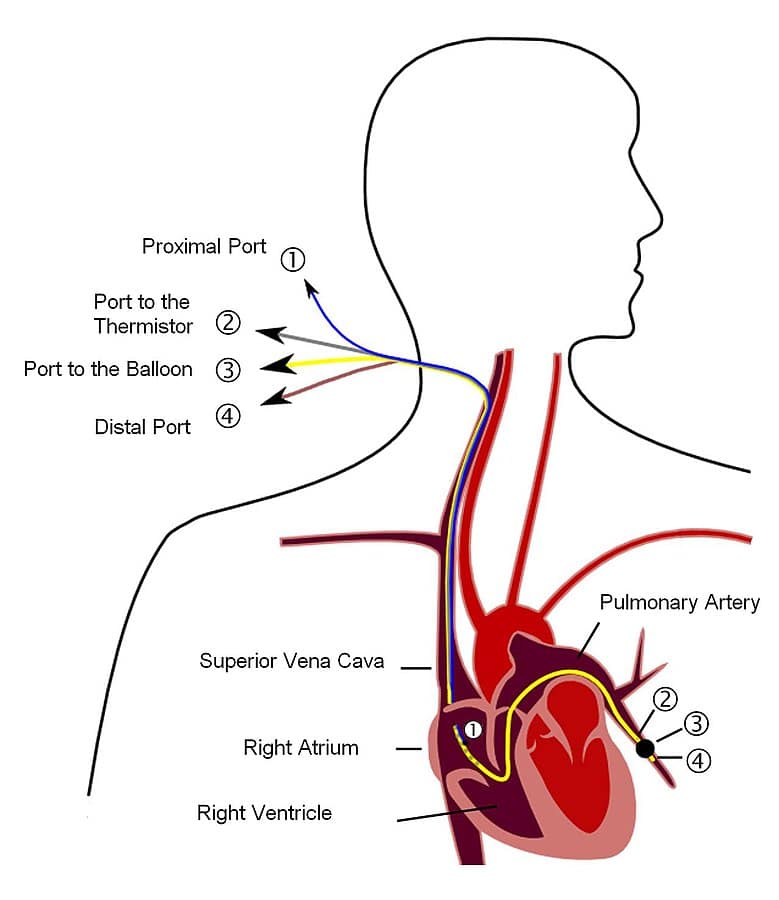 Pulmonary artery catheter measures pressure in the heart and nearby vessels - diagram.