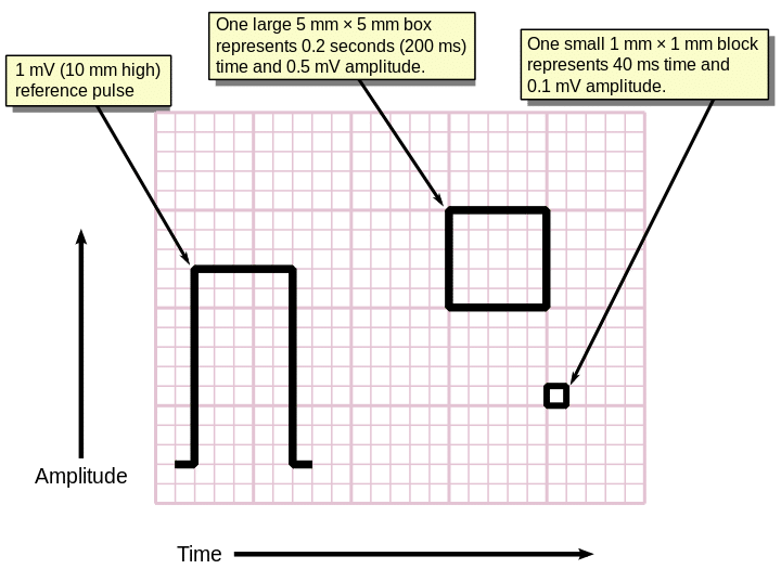 ECG grid lines.