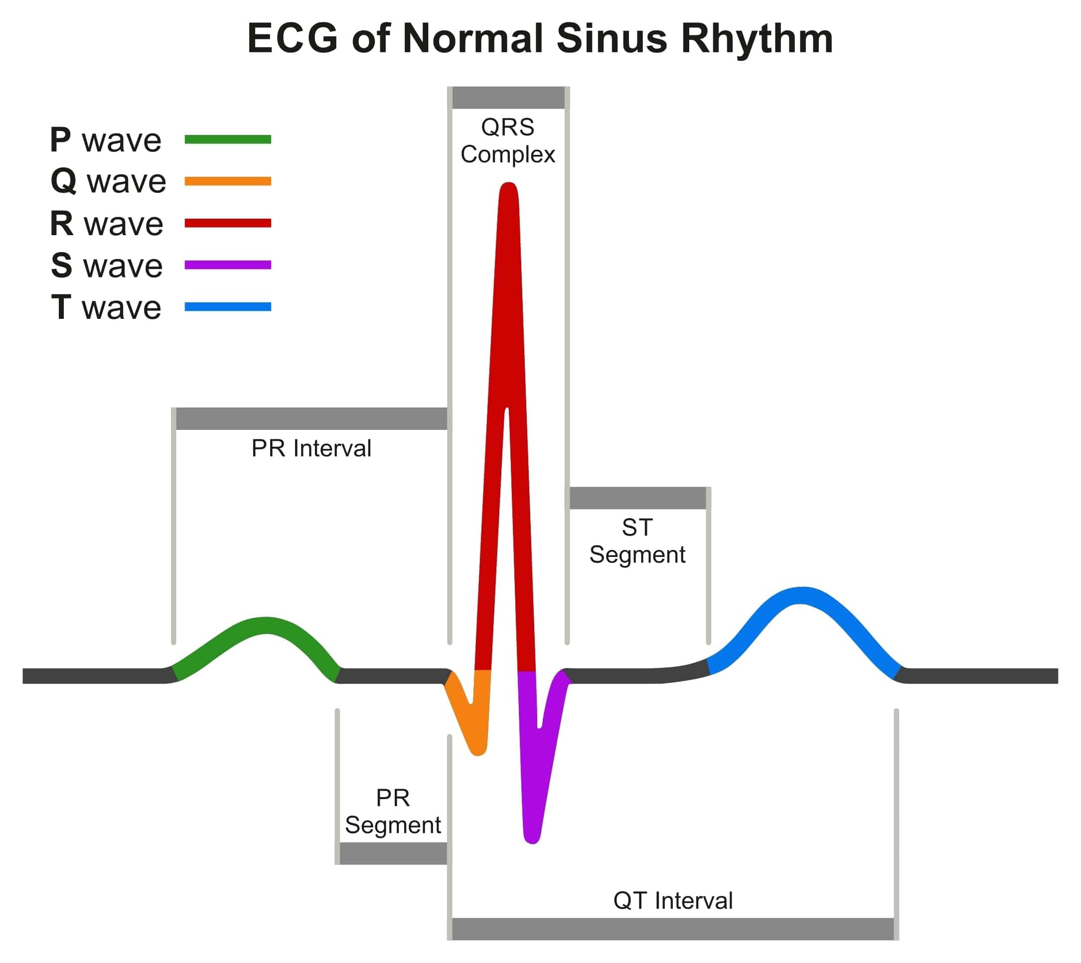 ECG tracing of a normal sinus rhythm.