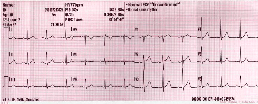 A normal sinus rhythm ECG output.