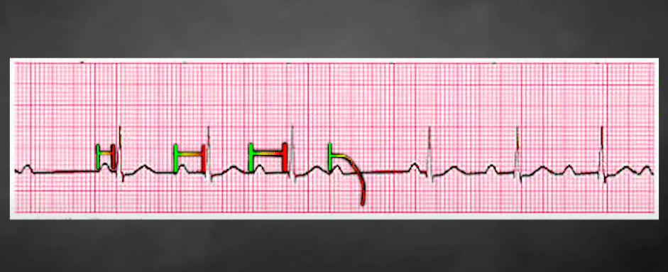 PR interval increasingly longer - ECG tracing