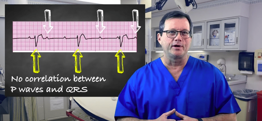 Third-degree heart block ECG strip.