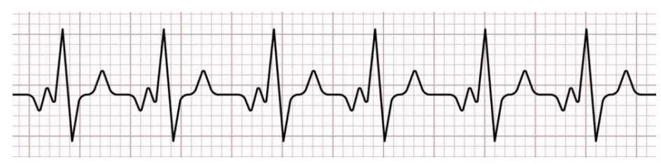 12-Lead ECG Heart Electrical Activity 12-lead ECG evaluates heart’s electrical activity.