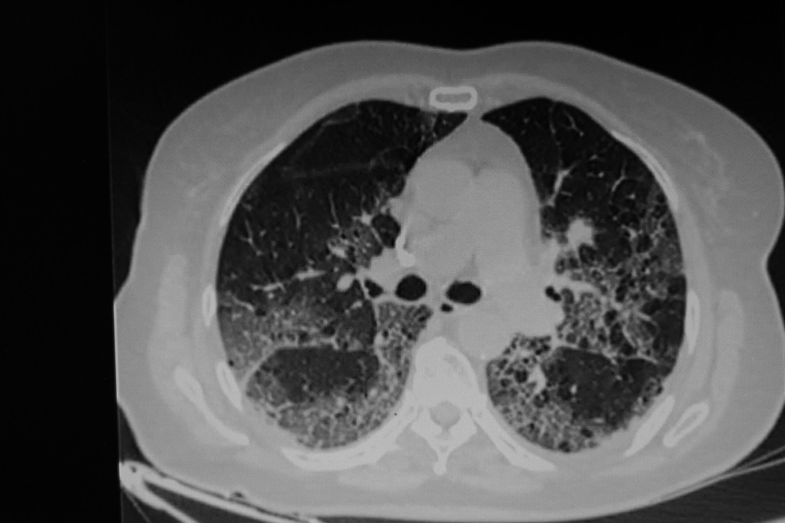 Chest X-Ray Interstitial Pneumonia Chest X-ray highlighting interstitial pneumonia - ground-glass appearance.