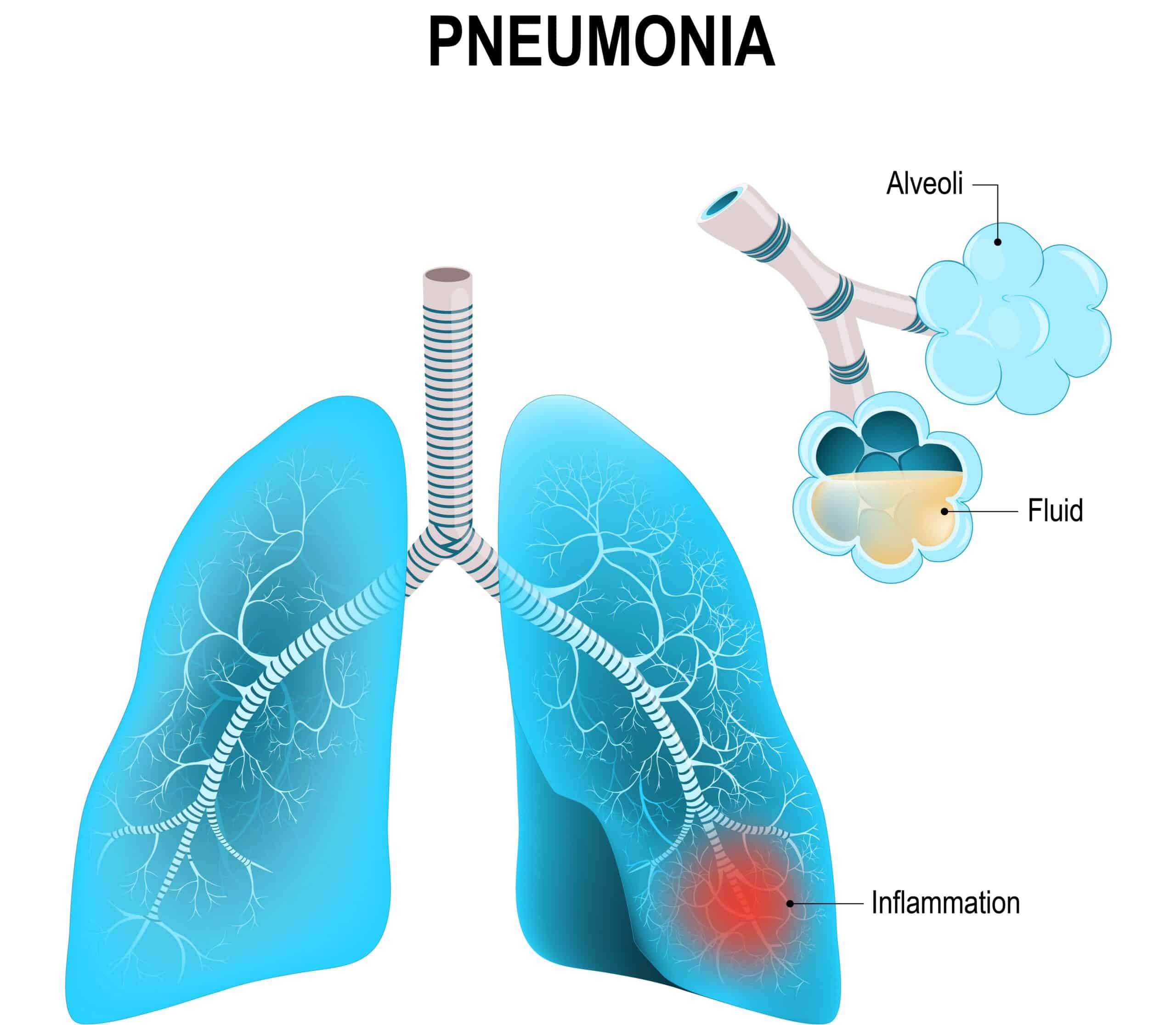 Pneumonia Pus Fluid Build-Up in Alveoli Pneumonia causes pus or fluid build-up in the alveoli - diagram of lungs presenting pneumonia.