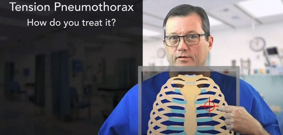 Insertion site for pleural decompression is midclavicular above the third rib.