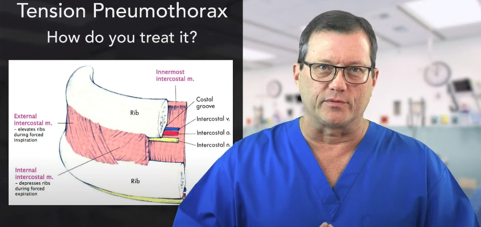 Physicians aim above rib to treat tension pneumothorax.