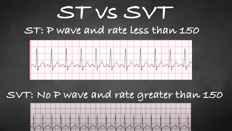 ST and SVT ECG Tracings.