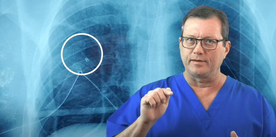 X-ray of a needle kinked at the bone.