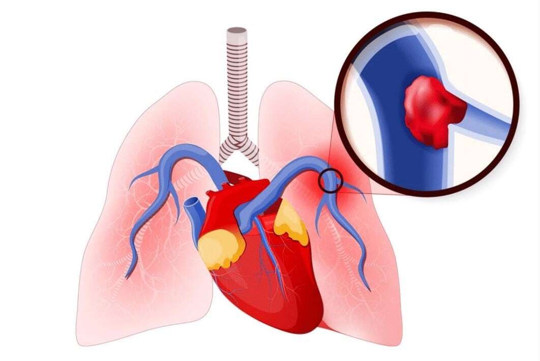 Pulmonary Thrombosis Blood Clot Lung Artery Pulmonary thrombosis occurs when blood clot is in lung artery.