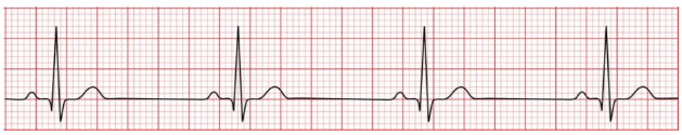 ECG-depicts-bradycardia.”