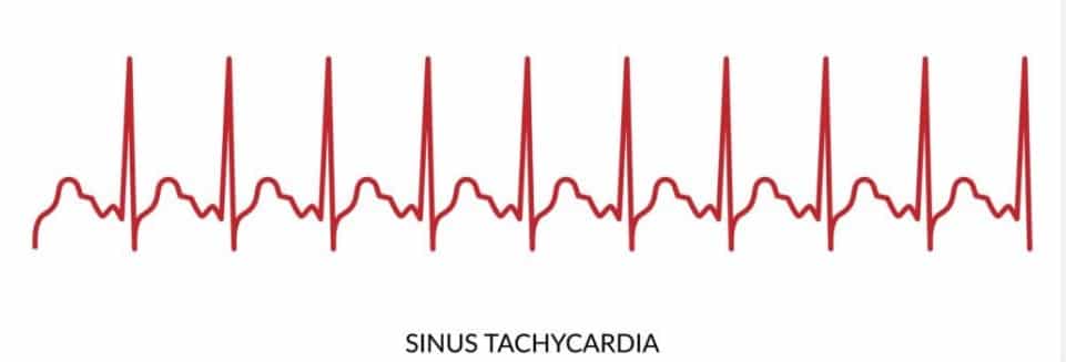  “Some causes of tachycardia are tachyarrhythmia and physiologic stress.”