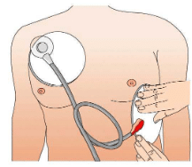 Proper placement of electrode pads.