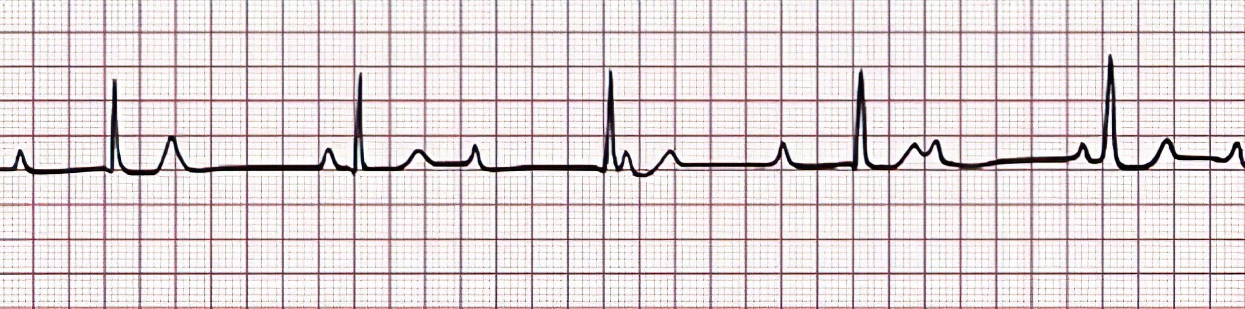 Arrhythmia 1 ECG.