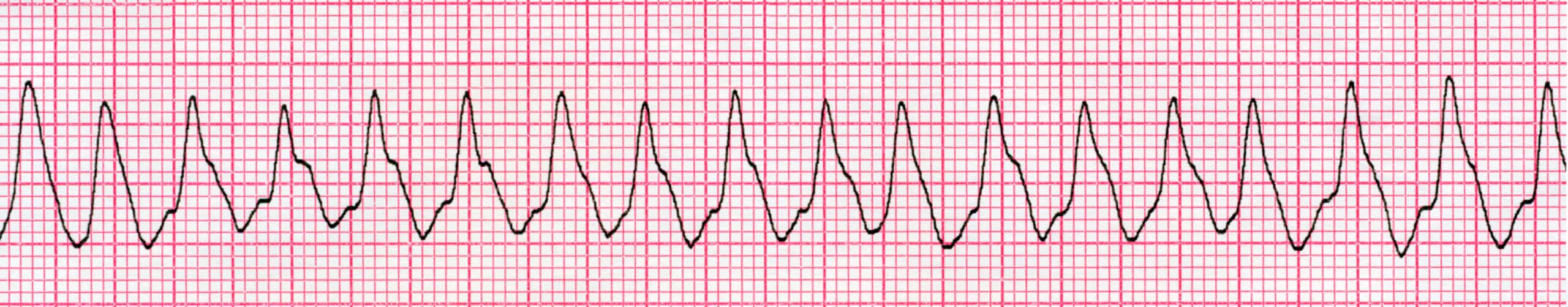 Arrhythmia 2 ECG.
