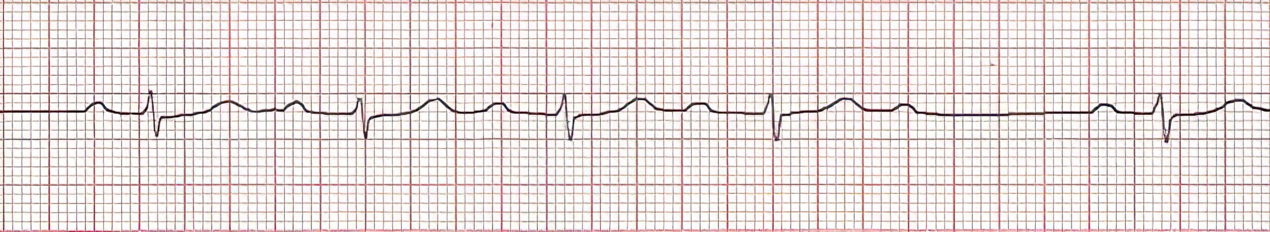 Arrhythmia 4 ECG.