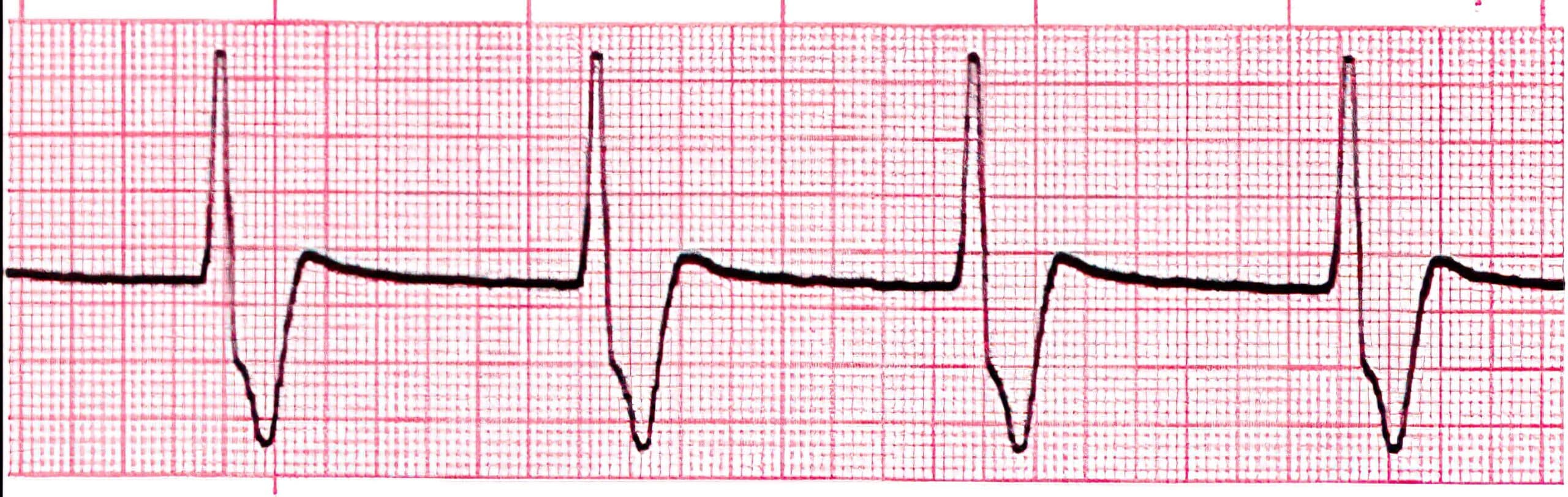 Arrhythmia 5 ECG.