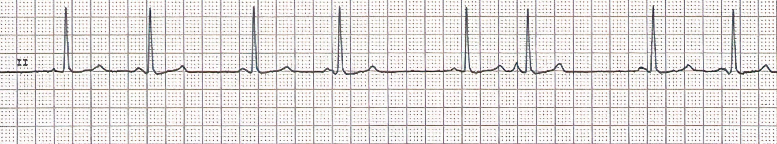 Arrhythmia 7 ECG.