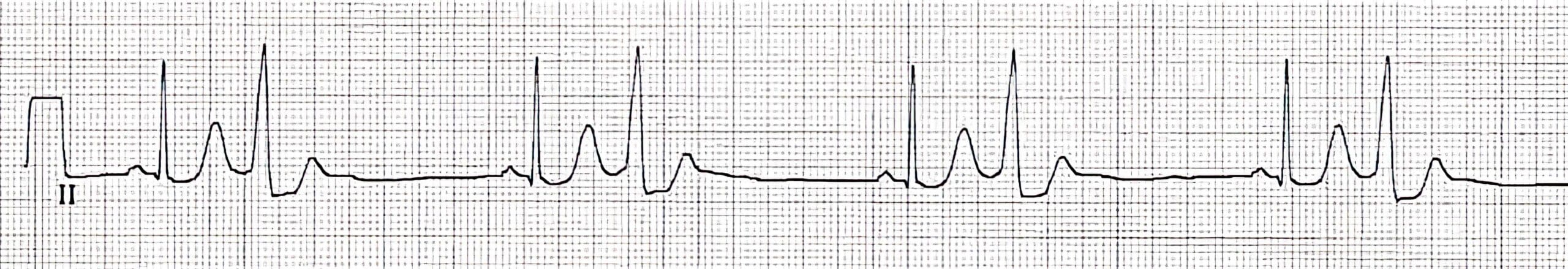 Arrhythmia 8 ECG.