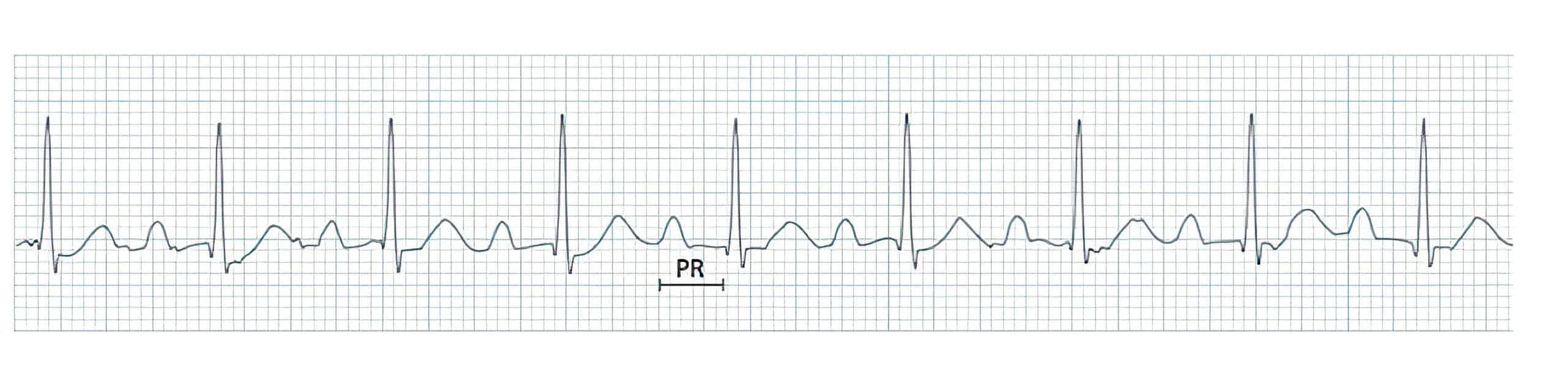 Arrhythmia 9 ECG.