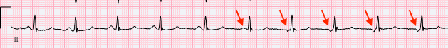 P wave morphology with slight irregularity of R-R interval.