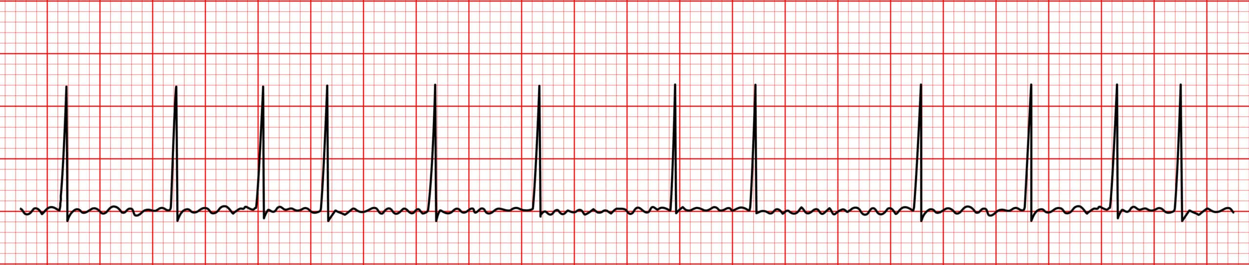 Atrial fibrillation ECG reading.