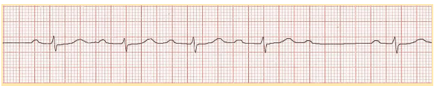 Second-degree atrioventricular block with four QRS complexes followed by absent complex.