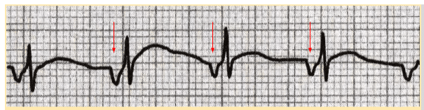 Retrograde conduction causes P waves to show negative deflection in lead II.