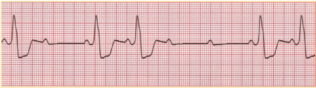 P waves are constant, there’s no PR interval prolongation, and R-R intervals are constant .