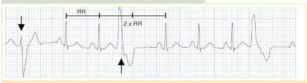 Compensatory pause following PVC does not affect sinus rhythm because SA node discharges at its own pace.