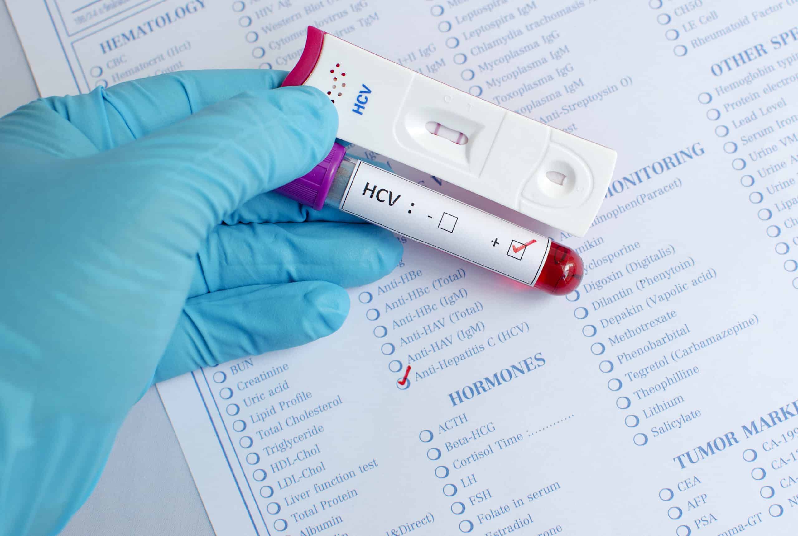Hepatitis C virus testing.