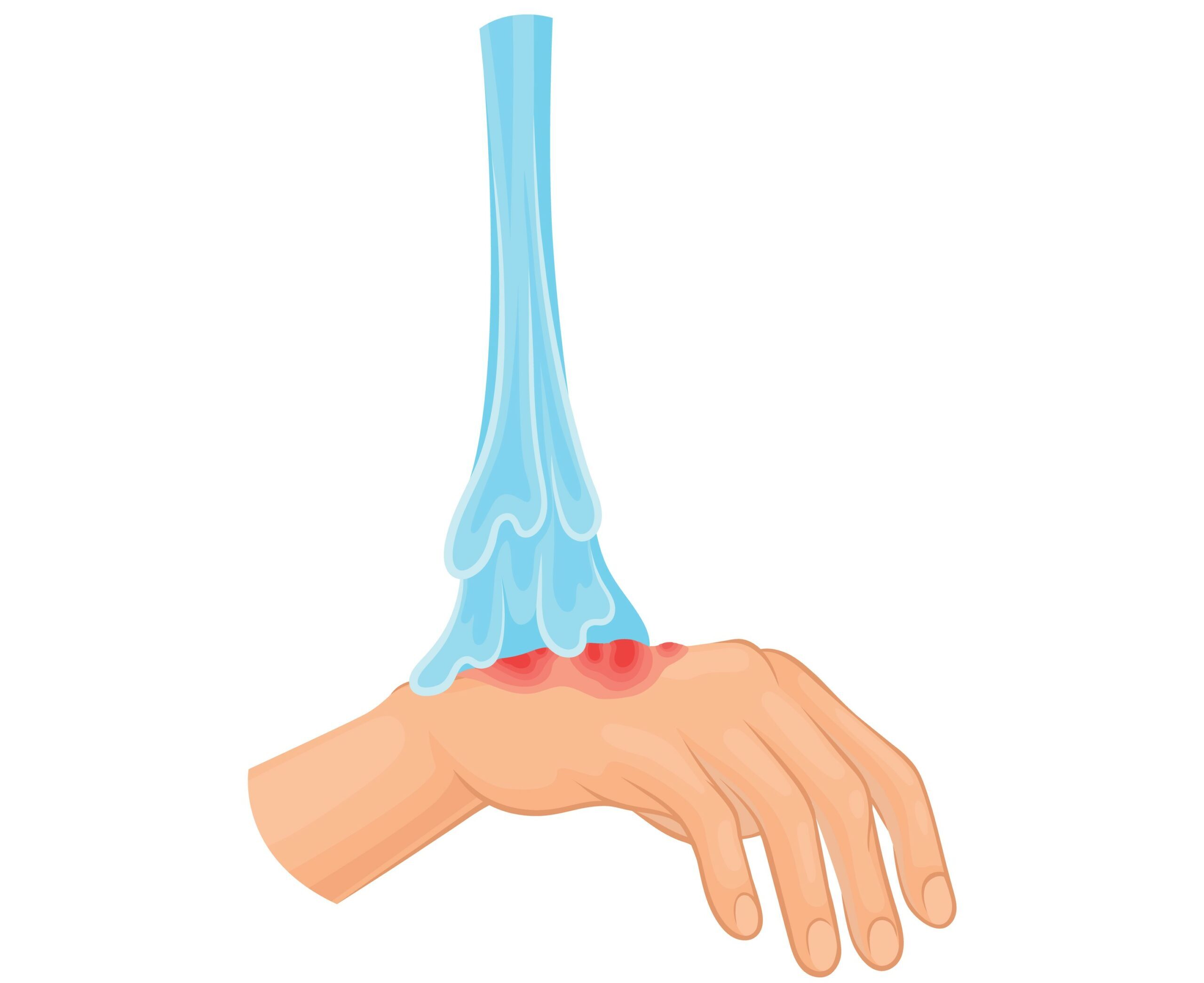 Chemical Burn Care Care of chemical burn - hand doused with water.