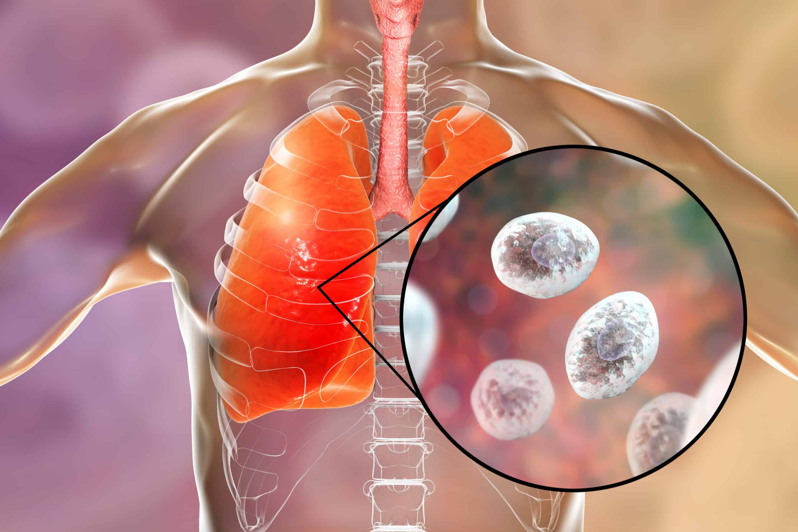 HIV - opportunistic infection of the lungs.