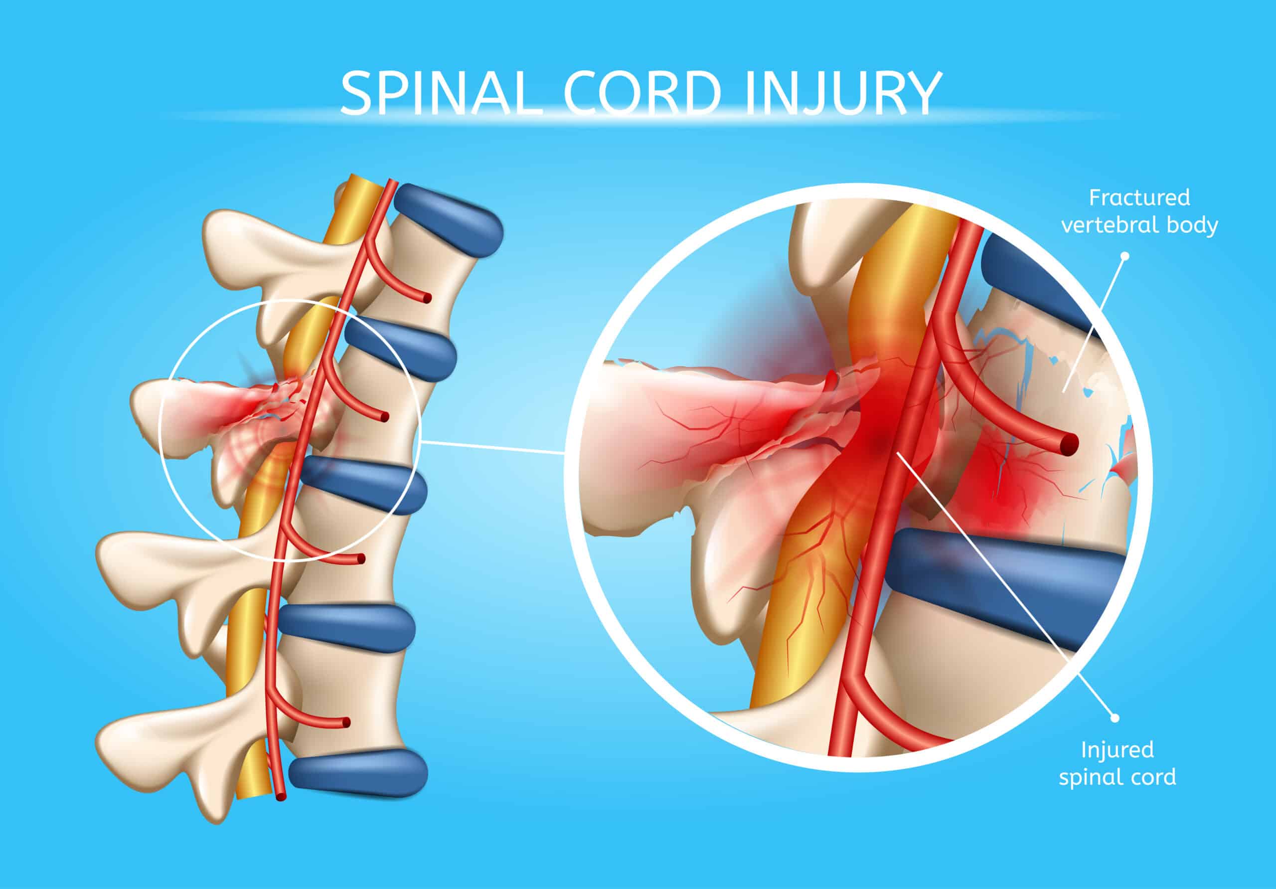 Diagram of a spinal cord injury.