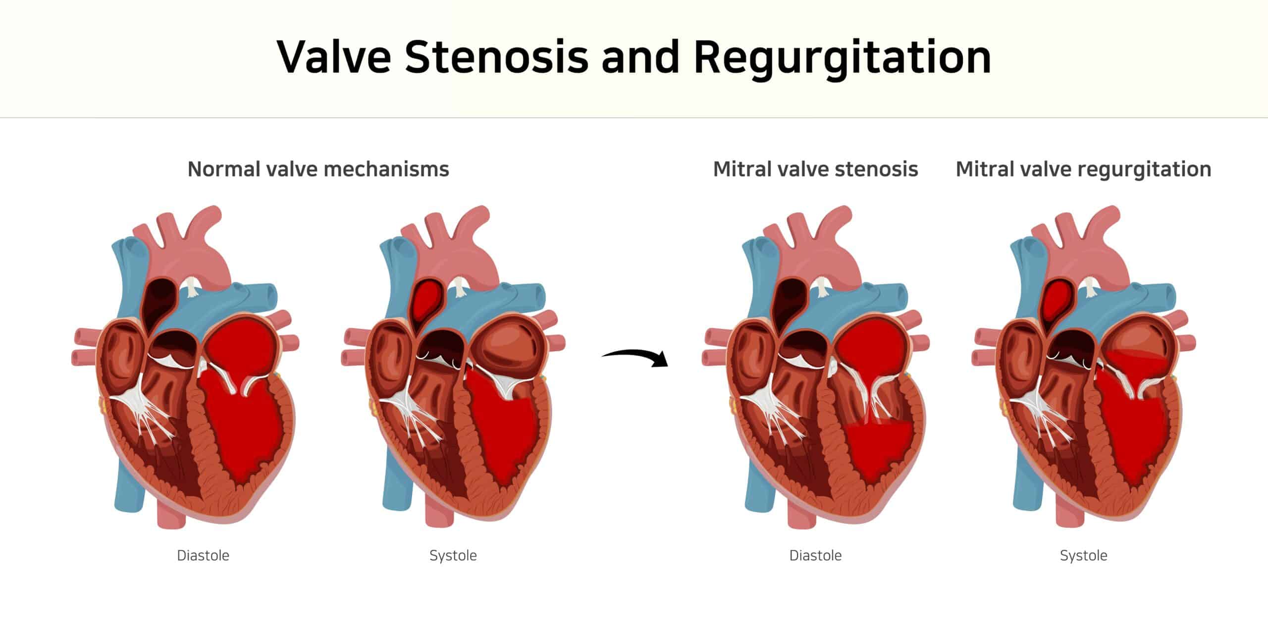 Stenosis and regurgitation involving the mitral valve - diagram of the heart.