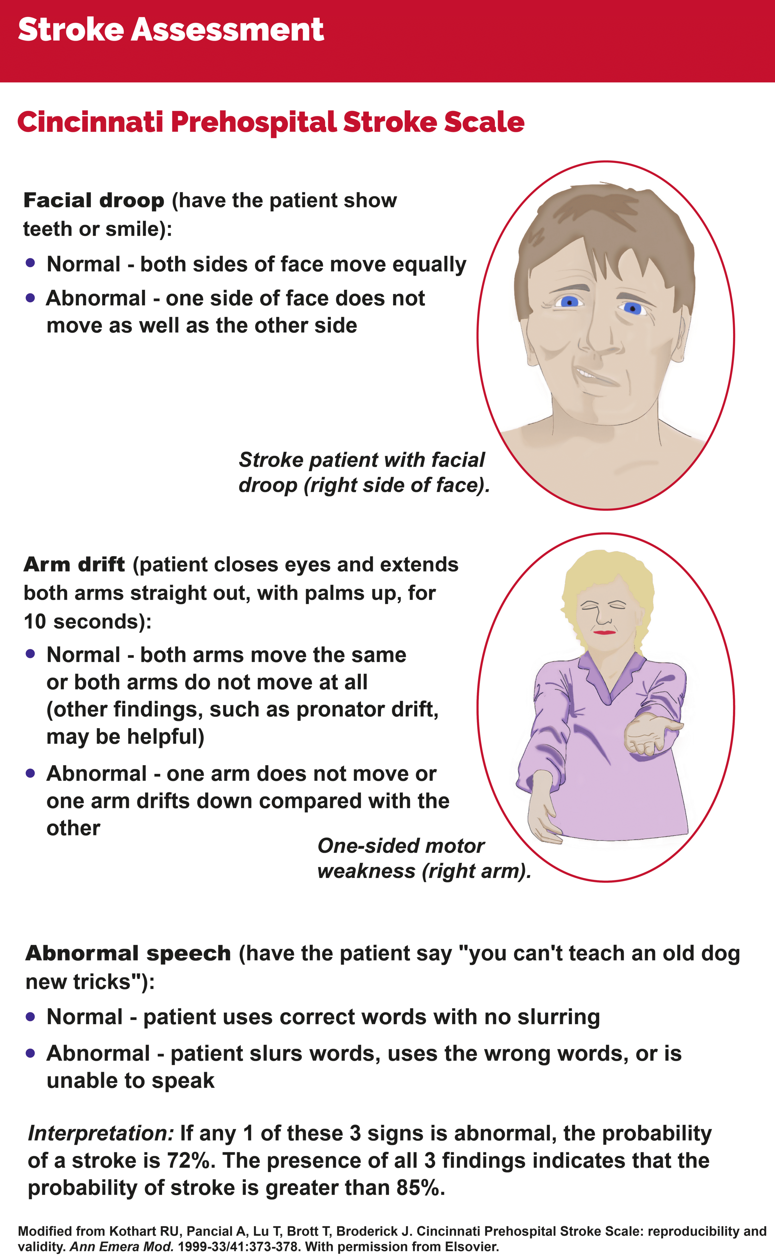 Cincinnati Prehospital Stroke Scale.