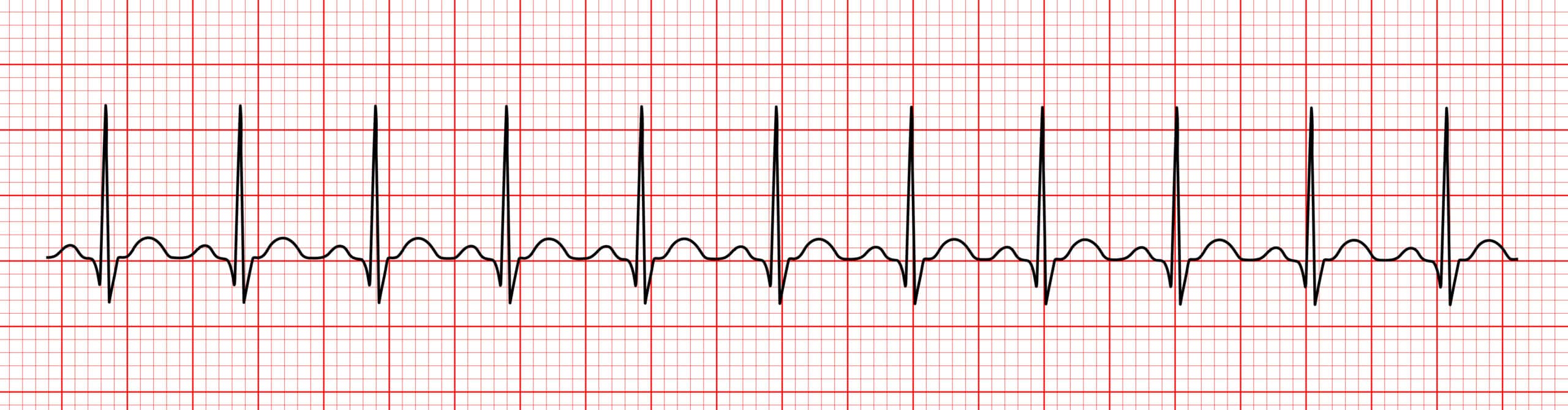 Defining the heart rate – Interpreting an ECG strip.