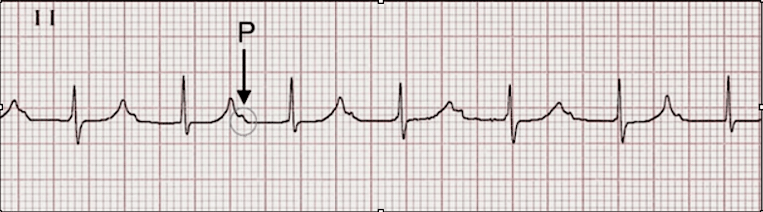 Finding the P wave – Interpreting an ECG strip.
