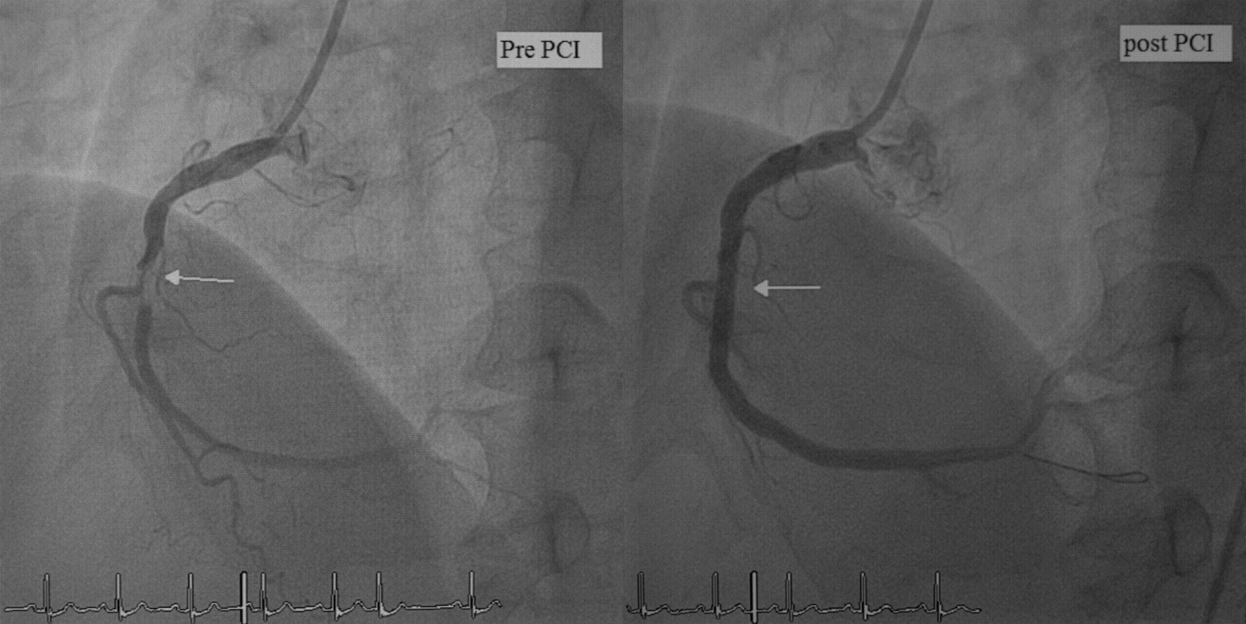 The percutaneous coronary intervention (PCI) procedure - images of the heart’s arteries.