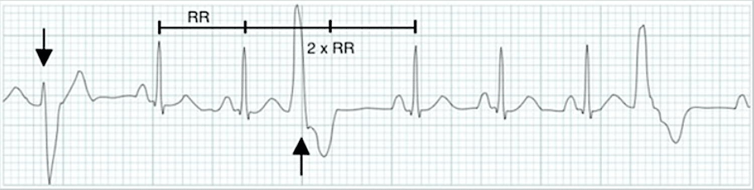 PVC and dropped R wave – ECG tracing.