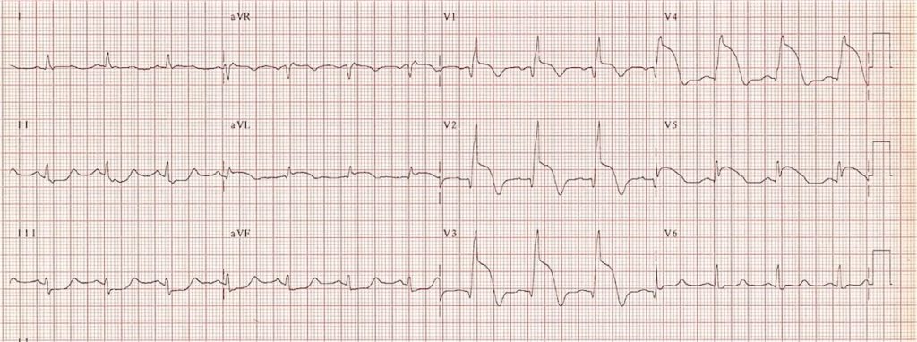 Acute Coronary Syndrome: Managing STEMI