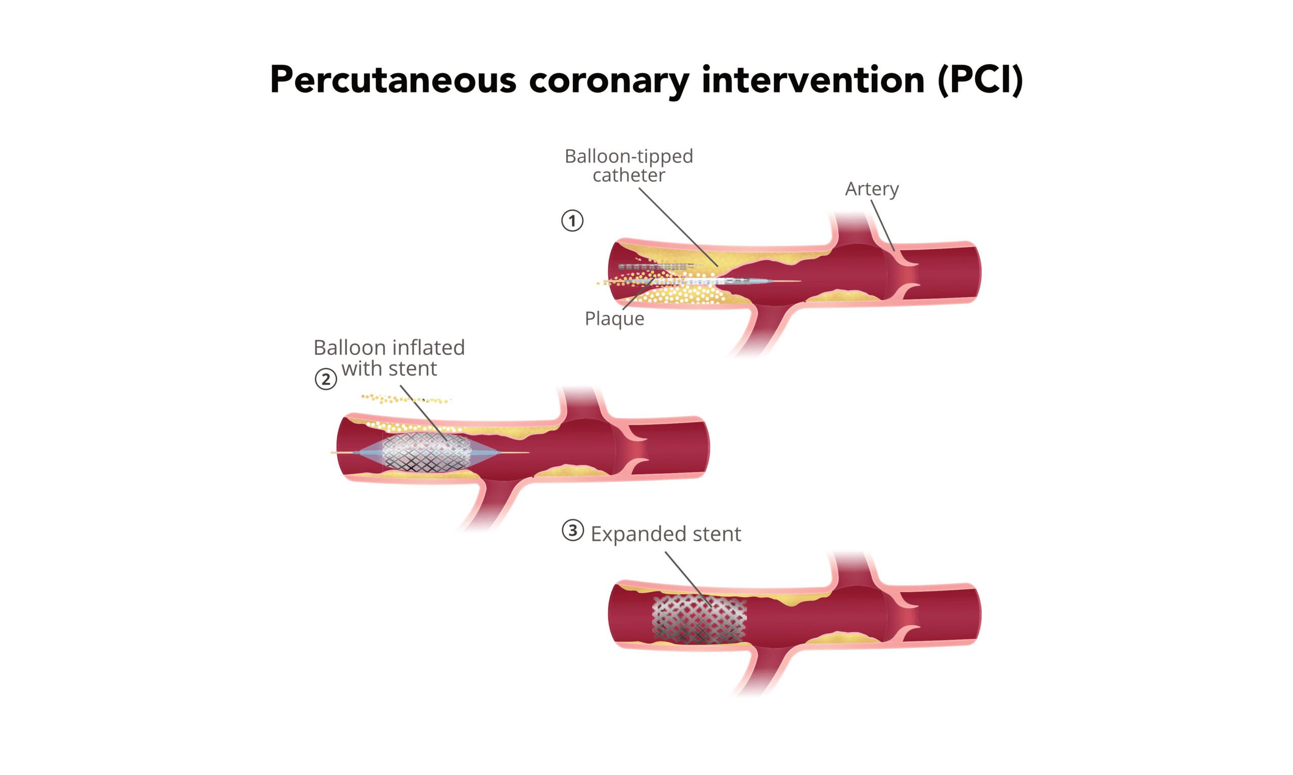 Treatment of STEMI - PCI procedure.