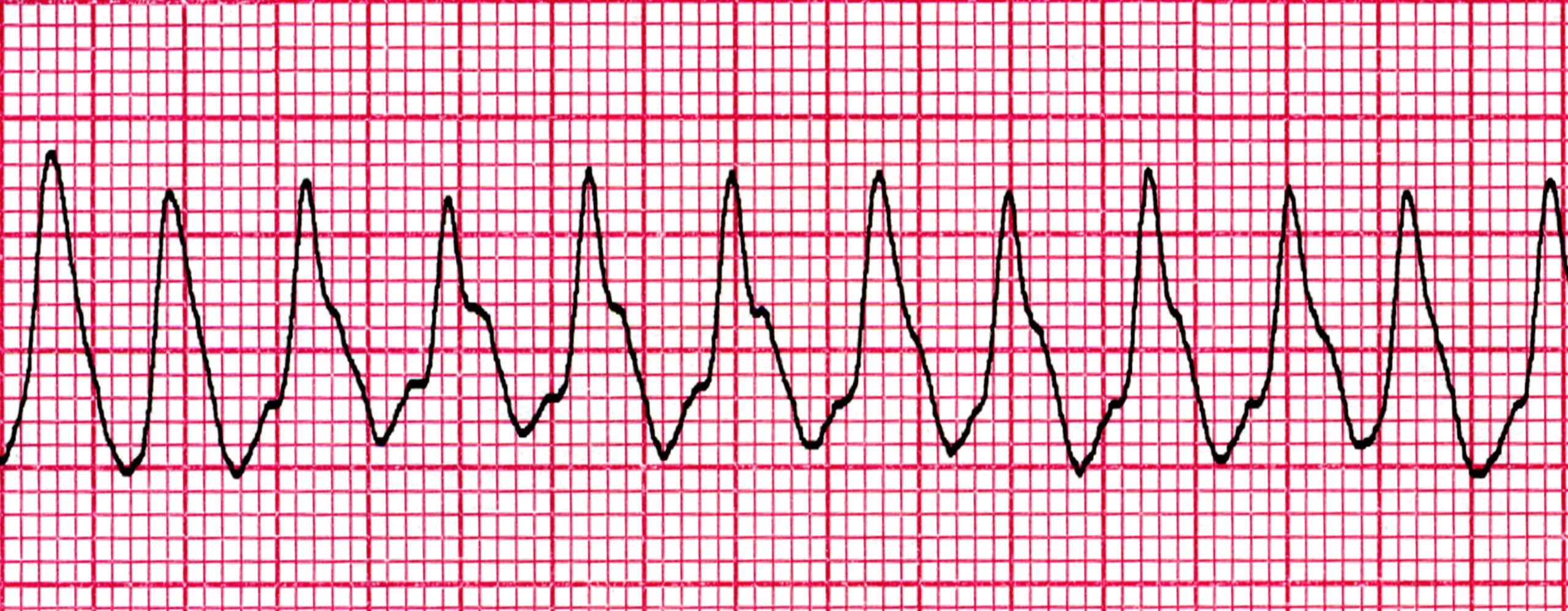 Ventricular tachycardia on an ECG strip.