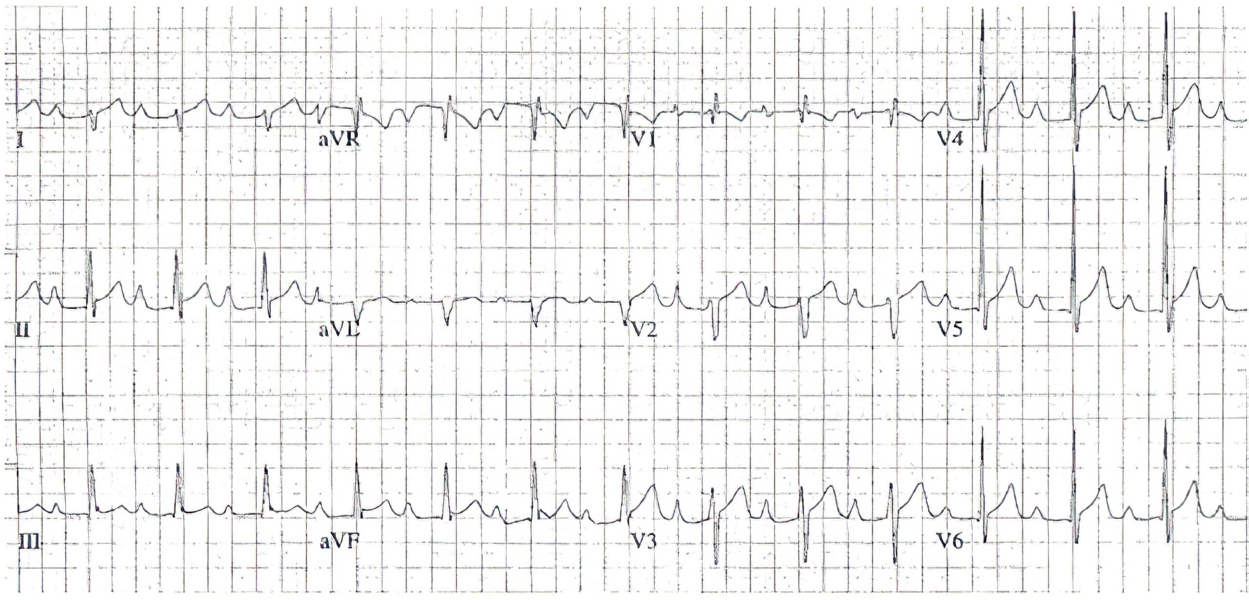 12-lead ECG depicting biatrial atrial enlargement.