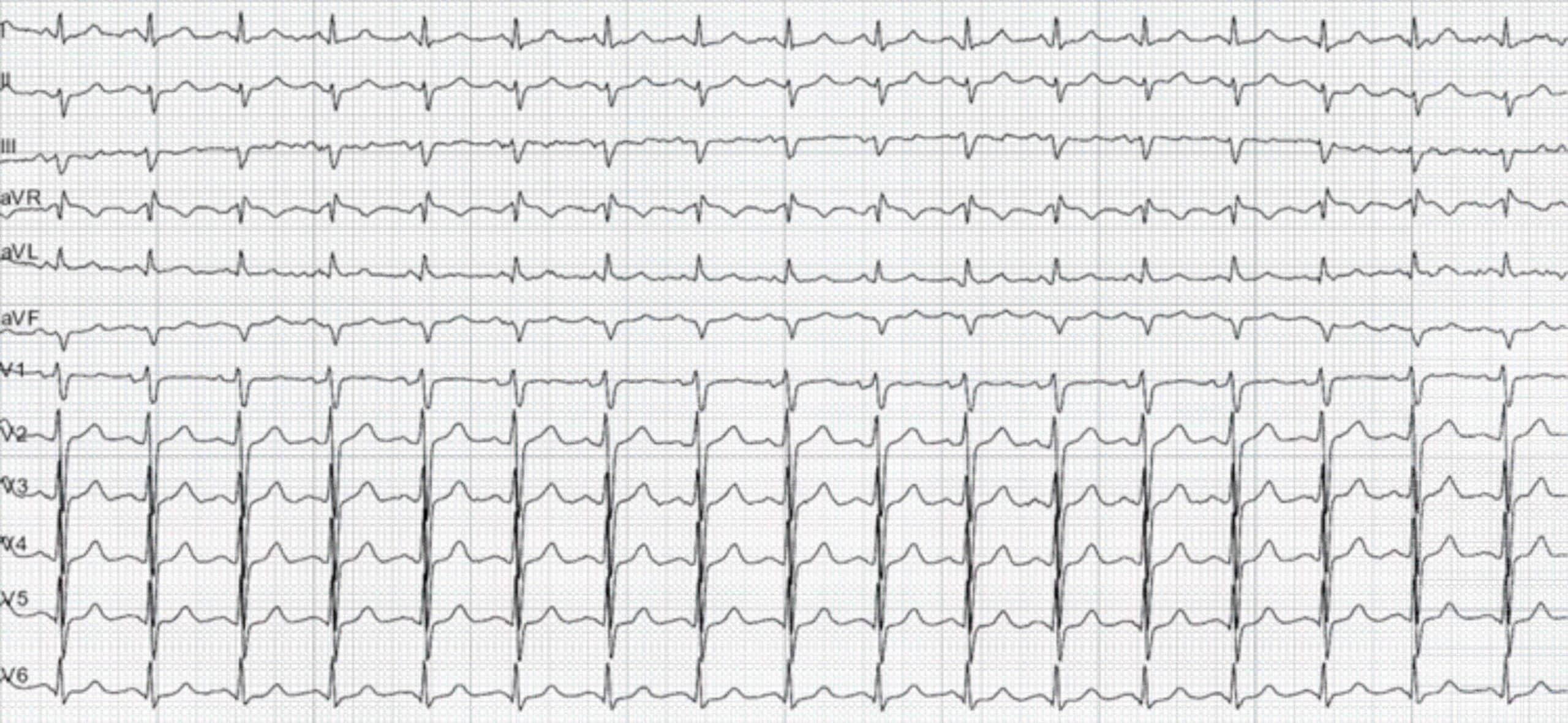 39-year-old man with inferior wall MI and LAFB ECG.