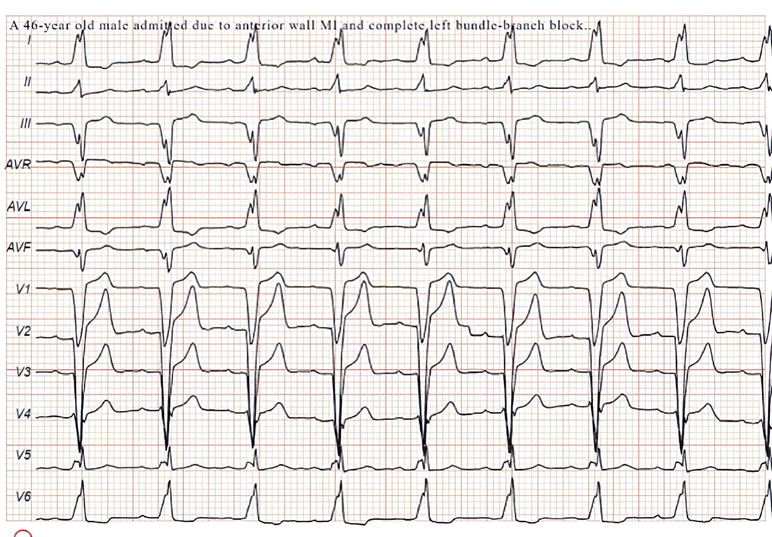 46-year-old man with complete LBBB ECG.