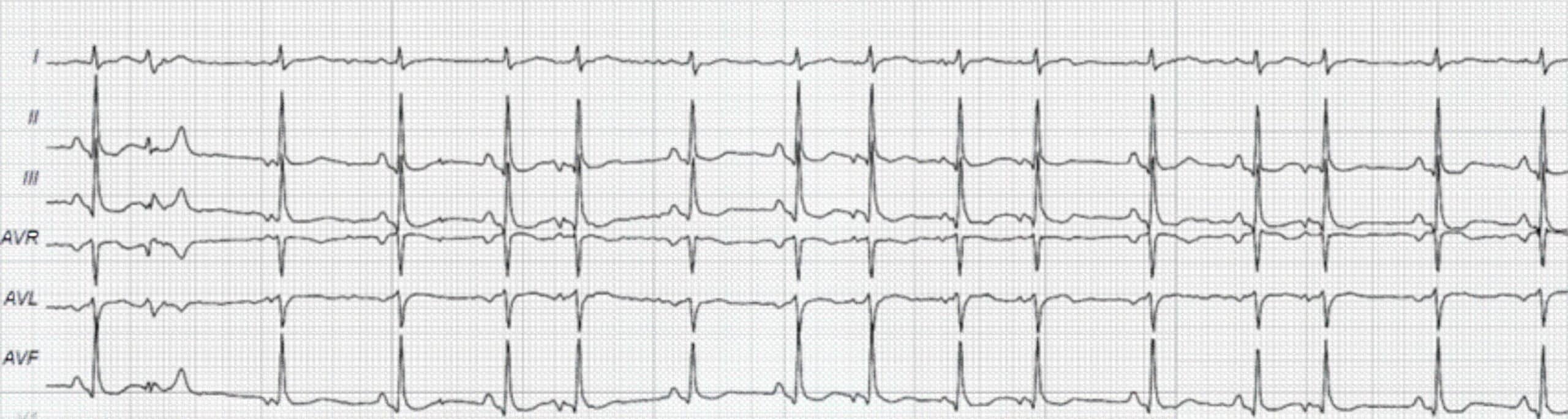 47-year-old man during annual physical ECG.