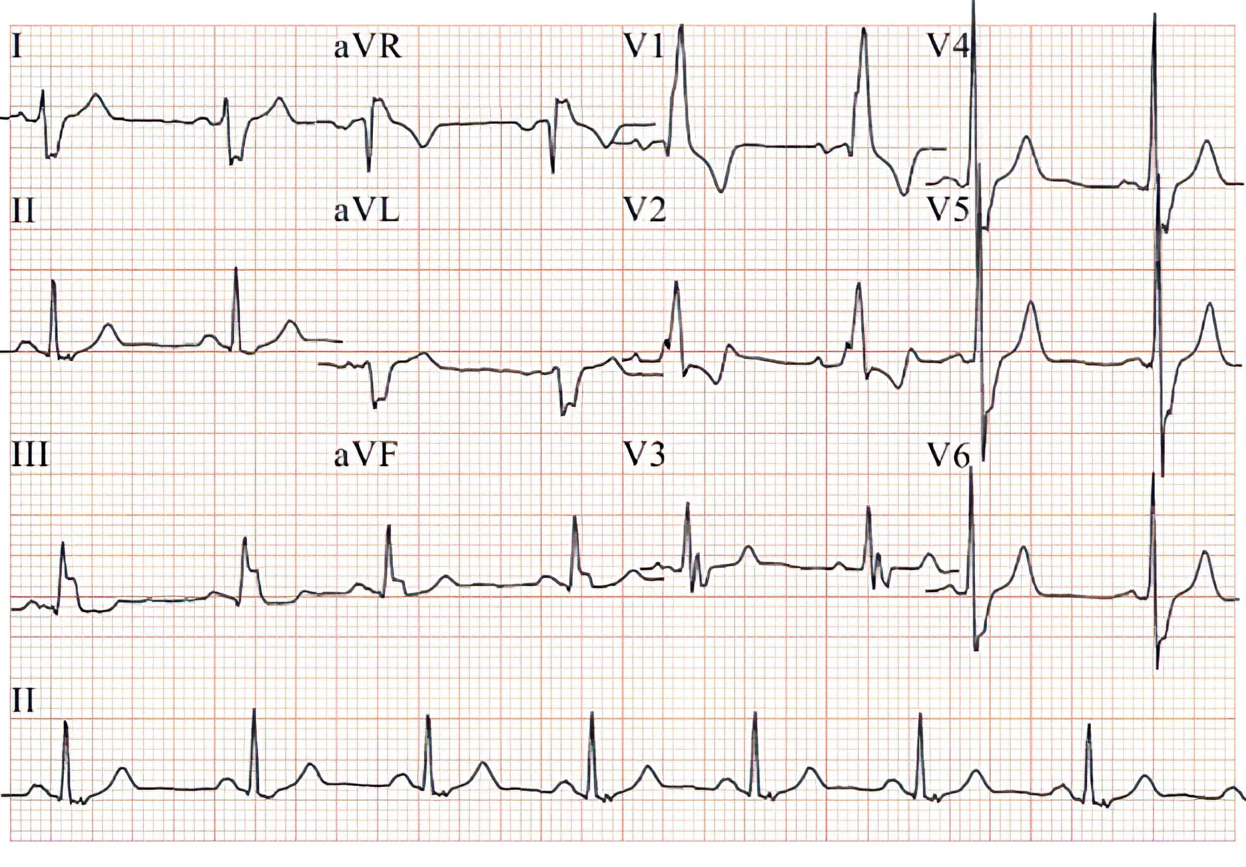 63-year-old man with bilateral bifascicular block ECG.