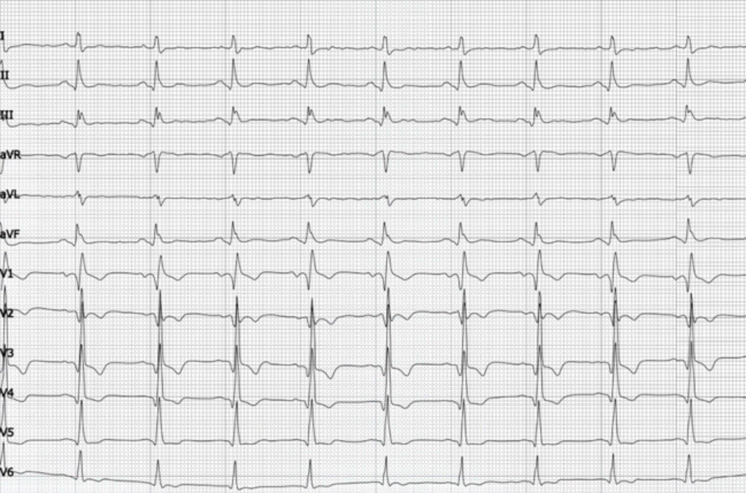 63-year-old man with old anterior wall MI and RBBB ECG.